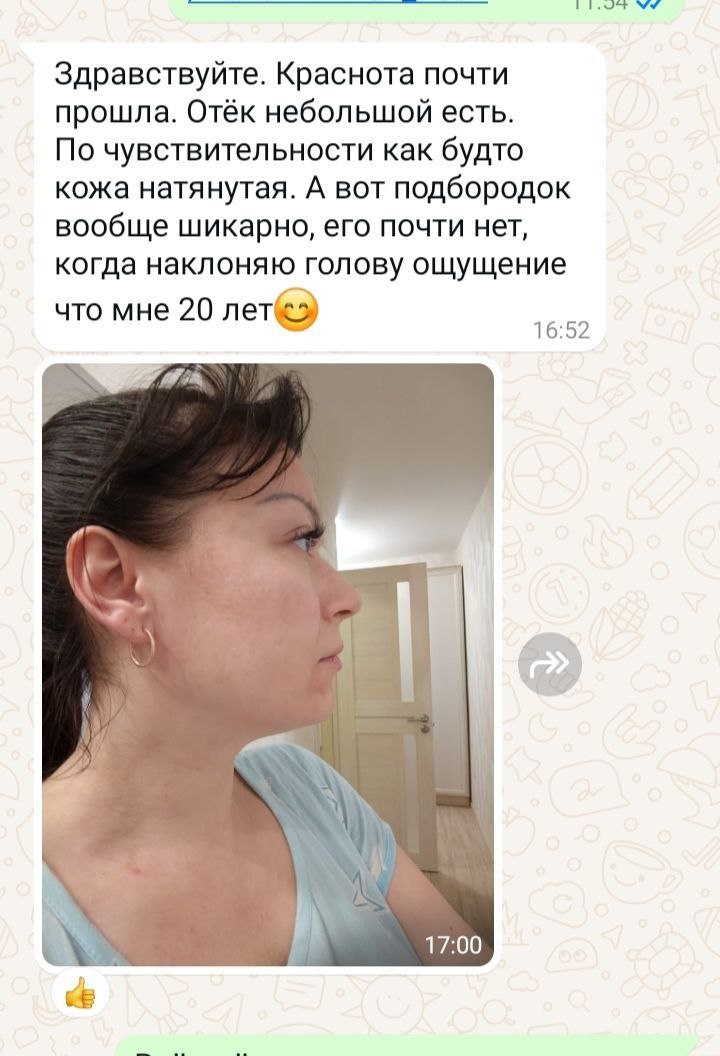 СМАС лифтинг по телу